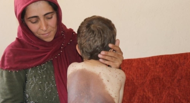 Küçük Samet vücudunu saran dev benlerin tedavi edilmesini istiyor